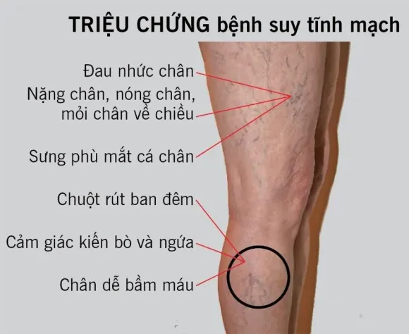 Suy Giảm Tĩnh Mạch: Triệu Chứng Đừng Thờ Ơ Và Liệu Pháp Phục Hồi Tại Phụng Tiên Spa